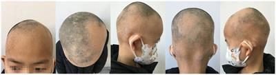 Case report: Sequential therapy with dupilumab and baricitinib for severe alopecia areata with atopic dermatitis in children